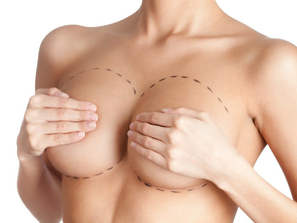 Breast augmentation