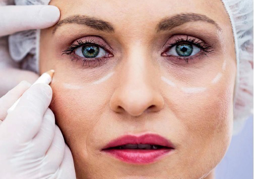 Eyelid cosmetic surgery - blepharoplasty