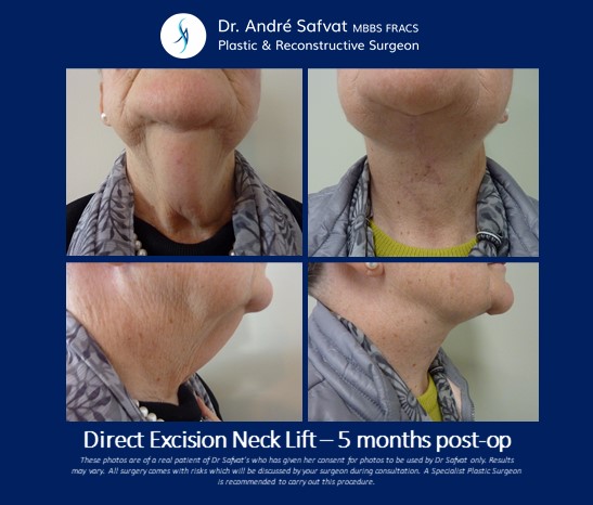 Direct Excision neck lift